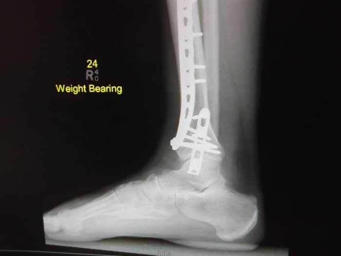 One of the 'weight bearing' xrays taken of his broken ankle. This is one of the side views. It is interesting to see the exact positioning of the plates and screws.