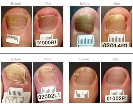 It is important to learn of any contra indications before you perform any nail treatment on your clients. This can range from fungal infection to cuts/open wounds bacterial infections or skin disorders.