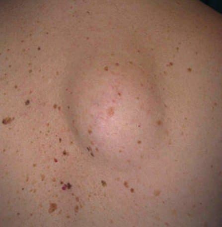 Pictures, Causes, and Treatment for Lipoma - HubPages