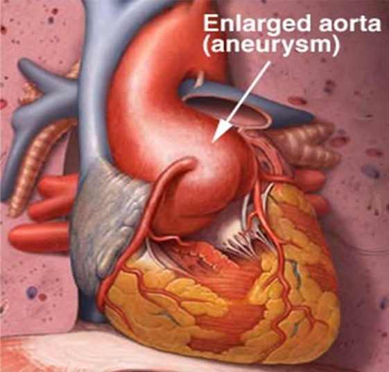 Enlarged Aorta Symptoms, Treatment, Surgery, Pictures HubPages