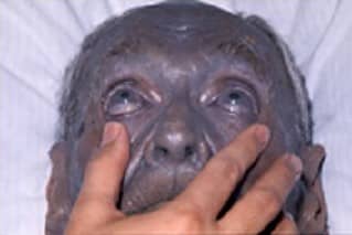 A case of argyria. Argyria has no known effect on health.