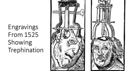 It was believed that drilling holes in the skull could cure mental disorders.