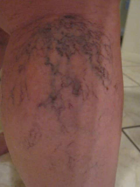A before photo of my lower right leg before treatments. As you can see, the veins are pronounced and dark.