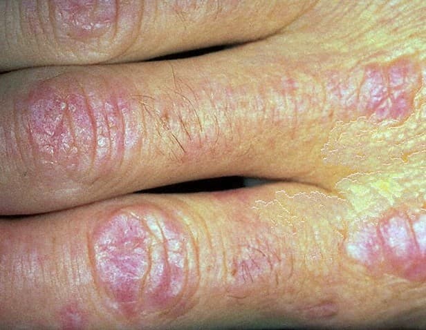 Dermatomyositis Pictures Symptoms Treatment Diagnosis Causes Hubpages