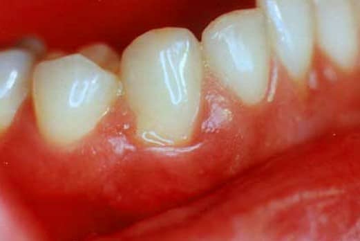 swollen-gums-in-a-young-adult-the-bmj