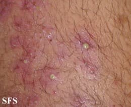 Staphylococcal folliculitis