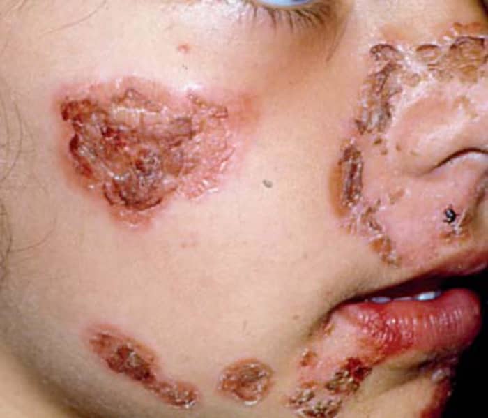 Impetigo on a child's face
