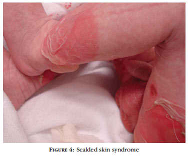 Staphylococcal scalded skin syndrome in an infant