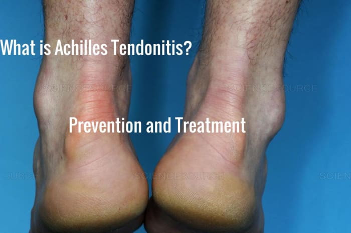 What Is Achilles Tendinitis? Prevention And Treatment - HubPages