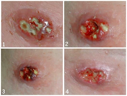 Watch for early stages . Even a rash with little white pimply sites can be a sign of infection especially when accompanied by red streaks.