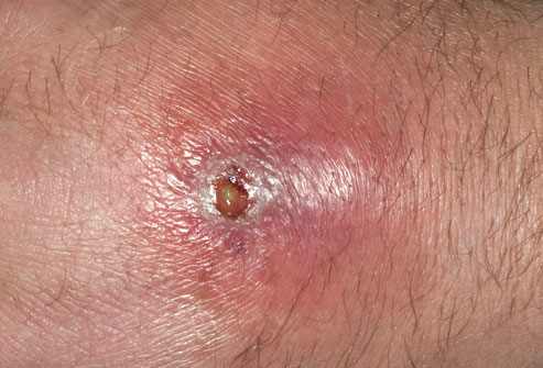 This is a photo of an infection filled with pus . The abscess needs to be drained by medical professionals.