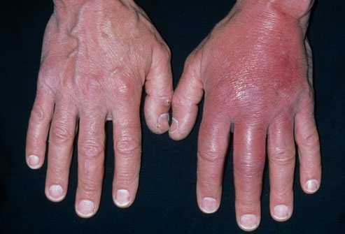 You can See where the second hand shows swelling called cellulitis caused by a serious case of MRSA