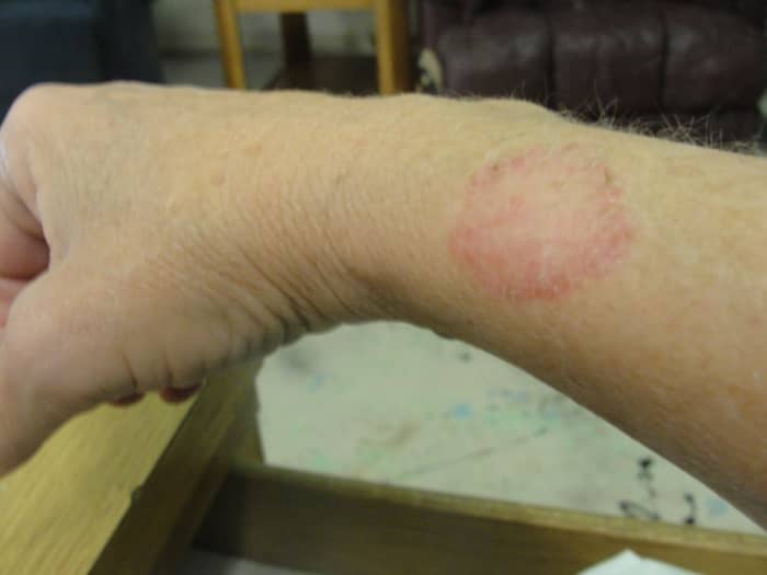 Individual in Western AR with chronic Lyme disease, tested positive in 2010. Rash recurs frequently. Has been cultured.