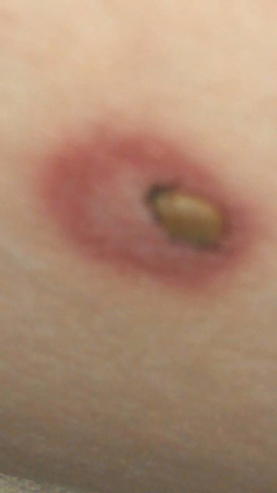 This Arkansas woman went to the doctor with this clear bulls eye and was told "...it's nothing, don't worry about it." You can see the tick is still embedded.