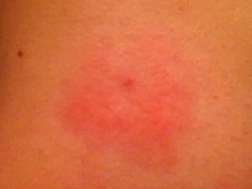 Rash from tick bite on individual in Little Rock. Source of photo informs author that rash originally had white clearing in the middle. The PCP positively identified as bulls eye; Individual clinically diagnosed with Lyme Disease
