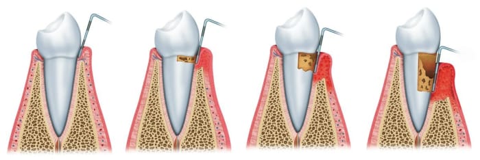 Gum disease progresses from minor irritation, to gingivitis, to periodontitis and advanced periodontitis, the point where you are at risk of losing the tooth. Protect yourself and your family with our guide!
