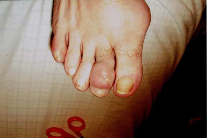Right Foot after 4 bottles of PURIXA. User reports that the tophi on this foot was the same as the left foot before starting PURIXA