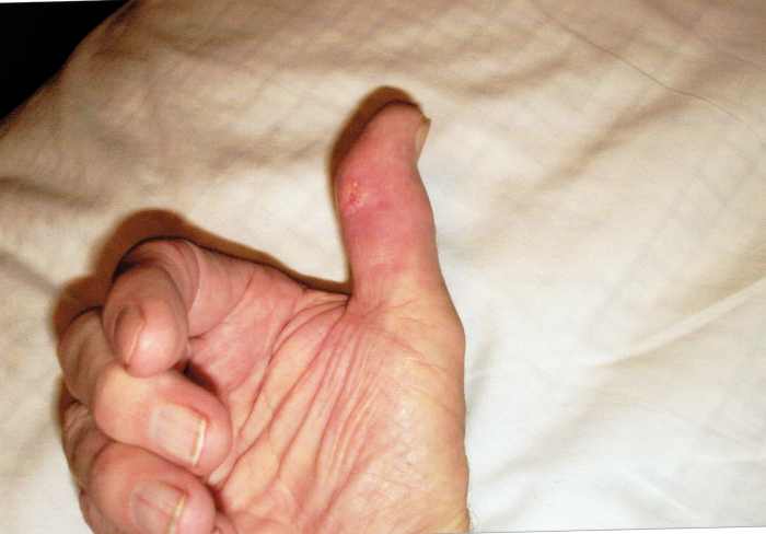 Right hand after 4 bottles of PURIXA. Uric acid dropped from 10.9 to 7.4 and included life style changes in addition to taking PURIXA.