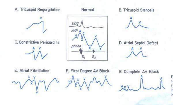 The evaluation of the venous pulse is an integral part of the physical examination since it it reflects both the mean right atrial pressure and the hemodynamic events in the right atrium