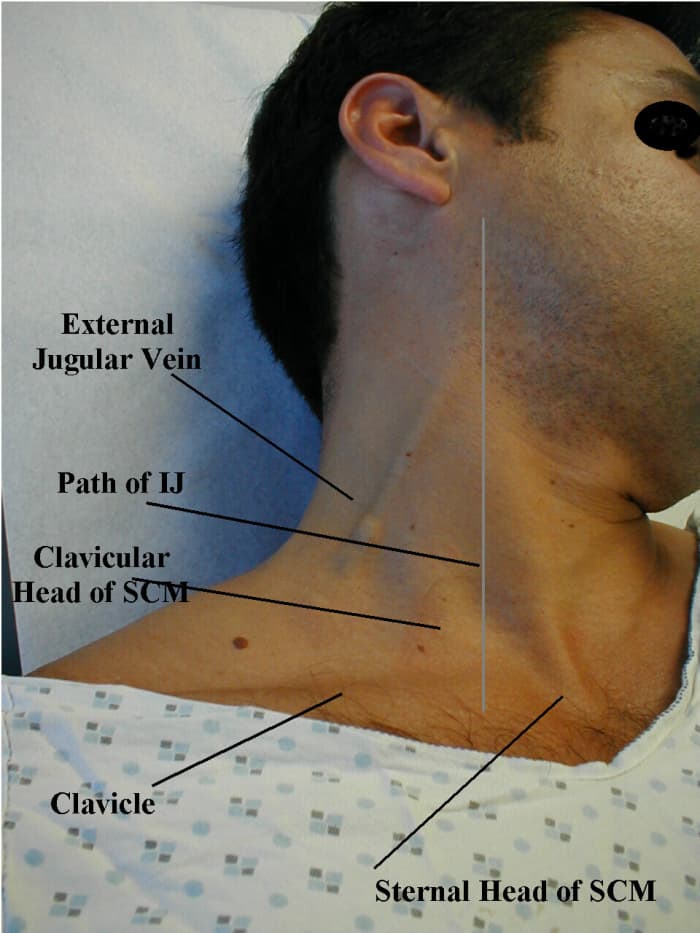 It is ideal to examine the internal jugular vein with the patient resting comfortably at an angle of 450. The jugular vein closely reflects the pressure changes within the right atrium