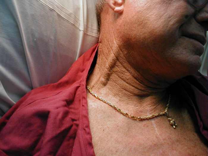 While observing the jugular vein, the abdominal wall is pressed. Rise in intra-abdominal pressure crives blood from the liver to the inferior vena cava, thus increasing the venous return to the heart. This results is rise of the jugular venous pressu