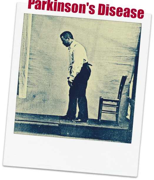 Multiple Choice Questions on Parkinson’s Disease HubPages