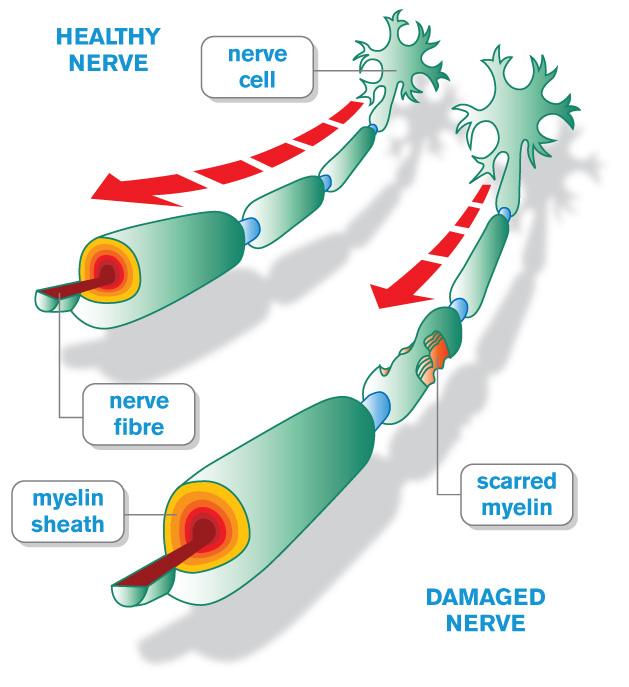 Fibromyalgia Symptoms, Treatment, And Current Research And The 