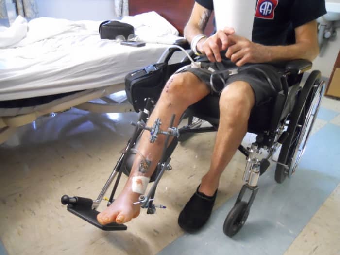 This is the result of healthcare neglect. Leg being supported by an external fixator. Photo shows tube coming from wound to a wound pump.