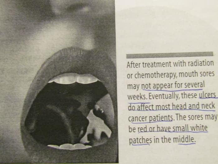 "After treatment with radiation or chemotherapy, mouth sores may not appear for several weeks. Eventually, these ulcers do affect most head and neck cancer patients. The sores may be red or have small white patches in the middle."