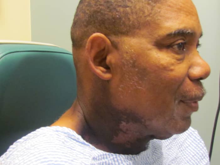 The burns and discoloration Walker, received on his neck area during the last few weeks of his treatment of radiation which are gradually healing with treatment of creams.