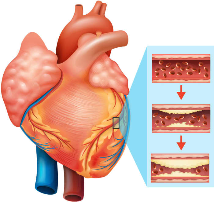 Plaque build-up in the arteries can restrict blood flow. However, this issue is often hard to diagnose.