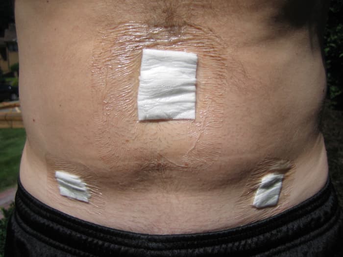 You can see bandages (gauze covered with waterproof plastic tape) where the three incisions were made: directly above the belly button and on the right and left side, just below the pant line. There is some residual swelling of the abdomen. The res
