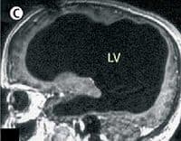 The image of a brain with massive damage whose owner has normal language function Credit: The Wikipedia