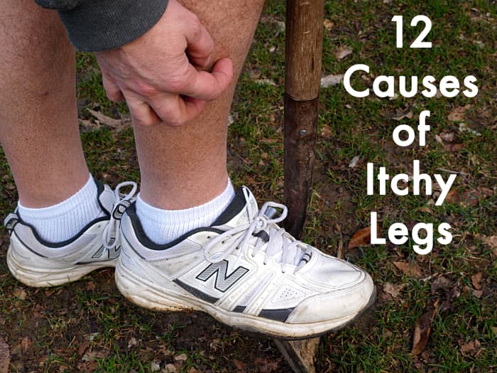 12 Causes of Itchy Legs HubPages