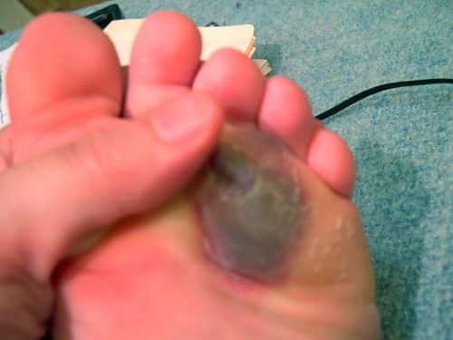 Honestly, this is one of the less gross pictures I found. My blister extended over a larger surface near the arch of my foot.