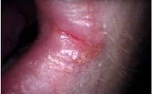 Angular cheilitis.