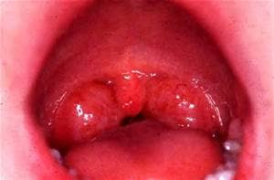 Strep throat presenting with inflamed throat. Severe inflammation is present. Sometimes white pustules can be seen on the throat and tonsils.
