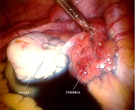 An actual laparoscopic view of a normal fallopian tube and ovary. The fleshy part of the tube (the fimbria) picks up the eggs. The ovary is the white structure.