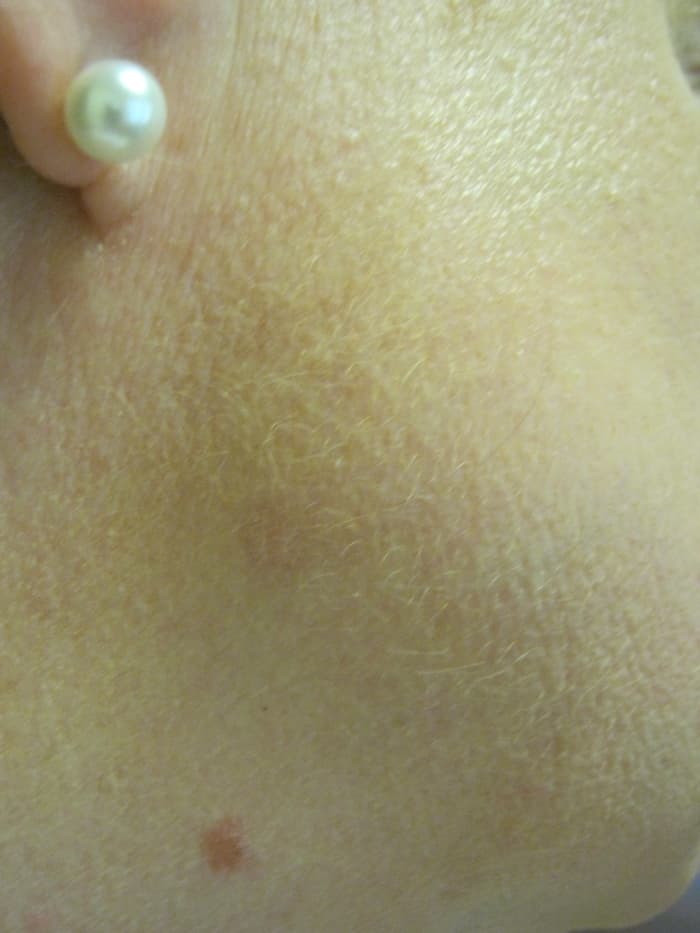 The place where two moles used to be, now this one is just a pink spot that keeps fading as weeks go by. It is about an inch above my other mole, that I still have. The one that disappeared used to be a fairly large, raised brown mole.