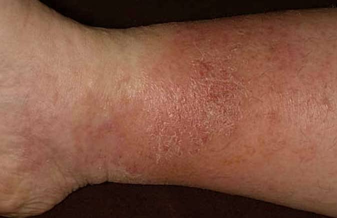 Lipodermatosclerosis Stasis Dermatitis