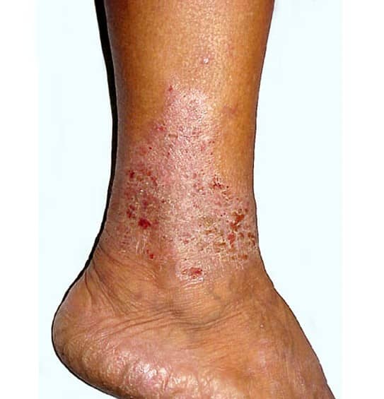 Stasis Dermatitis Pictures Symptoms Causes Treatment Diagnosis Hubpages