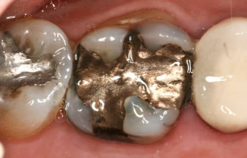 When two different types of metal come together in a solution, the metals effectively become a battery. In the mouth, this is called oral galvanism.