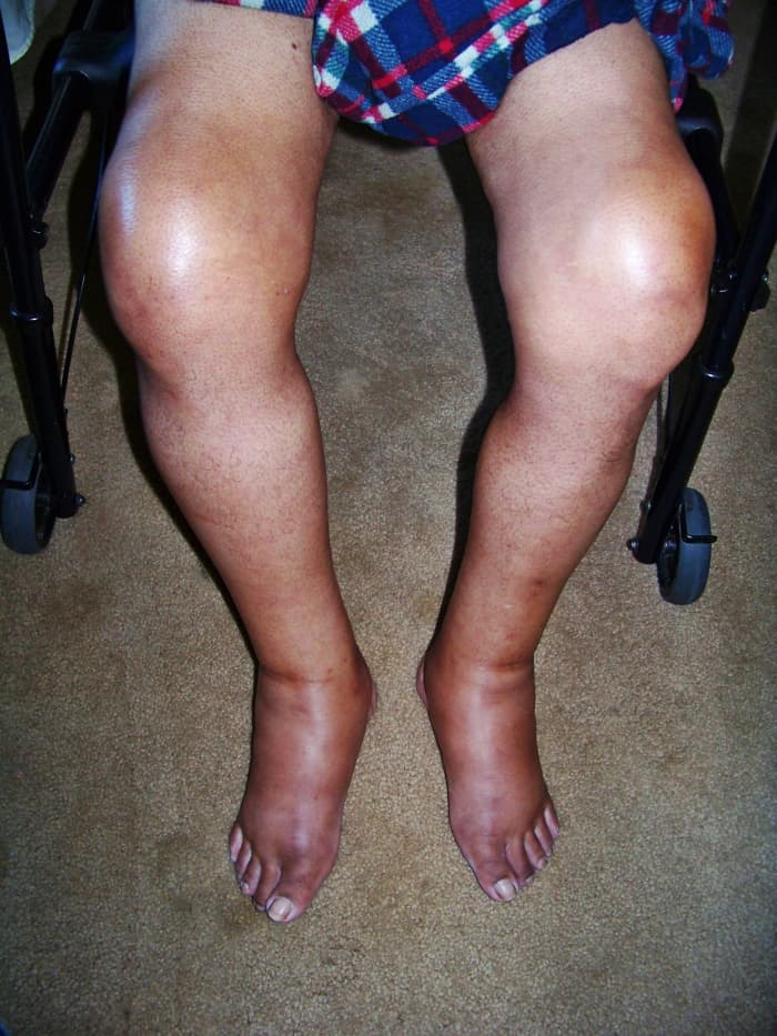 This picture was taken August 26th the surgery was on August 10th. The edema is getting better but the gout is still a problem.