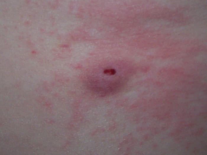Here is site of my ESWL procedure. The shockwaves left this welt and discoloration only for a couple of days.