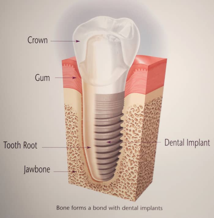 Diagram comparing natural tooth (on left) with implant tooth (on right). Image courtesy of Nobel Biocare patient education materials.