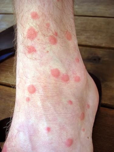 Mosquito Bites Treatment of the Itch - HubPages