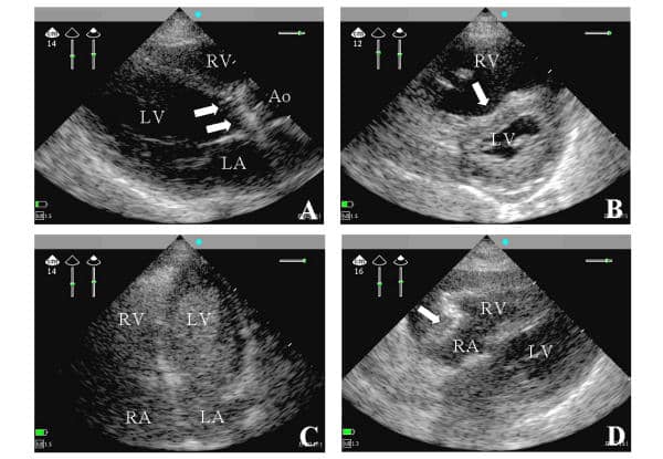 Examples of two-dimensional still frames obtained from hand-held echocardiographic examinations of four distinct patients.