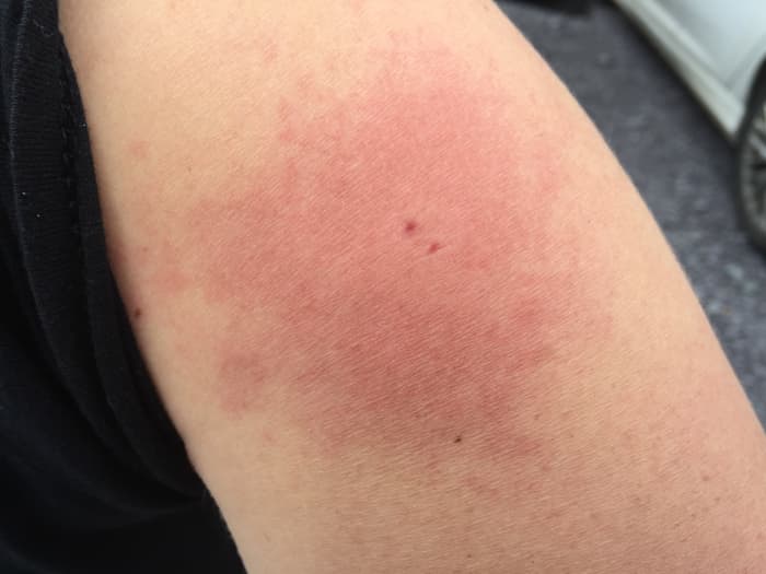 negative-reaction-to-a-horsefly-bite-my-recovery-experience-patient