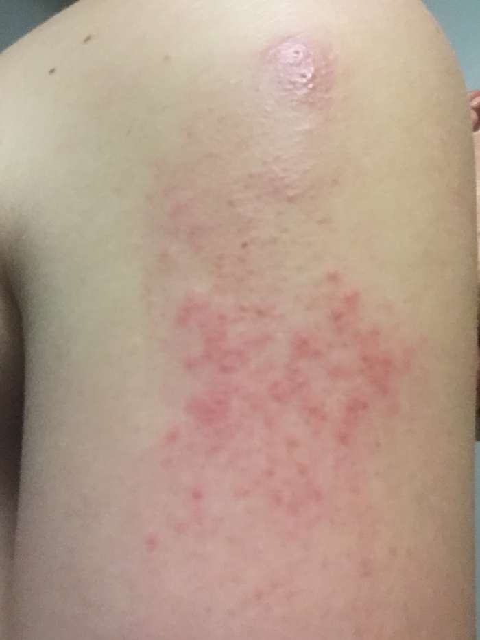 Negative Reaction to a Horsefly Bite My Recovery Experience Patient