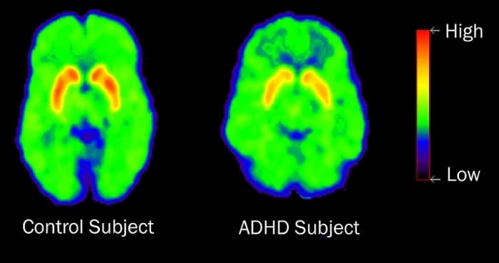 This brain scan shows dopamine activity in a normal brain (on the left) and an ADHD brain (on the right). Notice the normal brain's colors are brighter indicating more dopamine production vs the patient with ADHD and lower dopamine production.